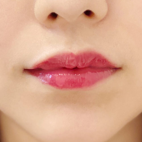 左右差を整えぷっくり可愛い唇にデザイン スマイルリップの処置直後の症例写真です 代女性 A Clinicは小顔 リフトアップ専門の美容整形クリニック