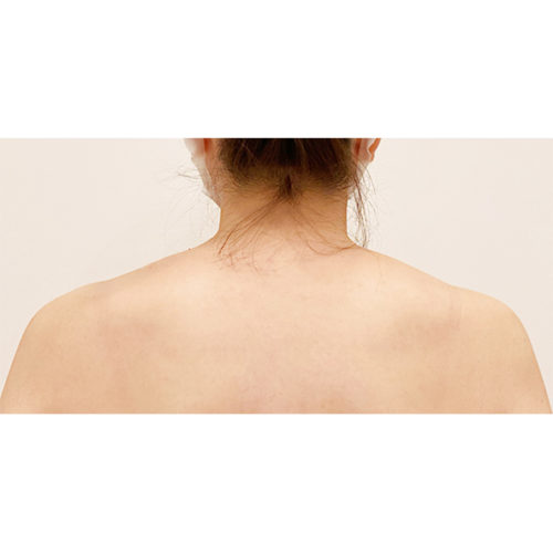 一度の注射で華奢な肩を手に入れられます 肩ボトックス注射の3週間後の症例です 30代女性 A Clinicは小顔 リフトアップ専門の美容整形クリニック