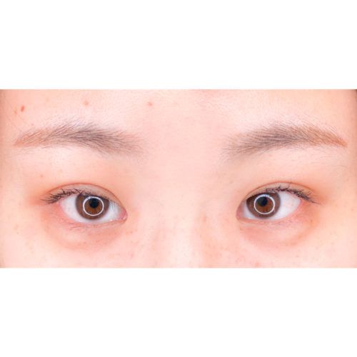 目の縦幅と横幅が広がりデカ目に 二重術埋没法とタレ目形成術クイック法の症例です 代女性 美容整形のa Clinic 美容外科 美容皮膚科 形成外科