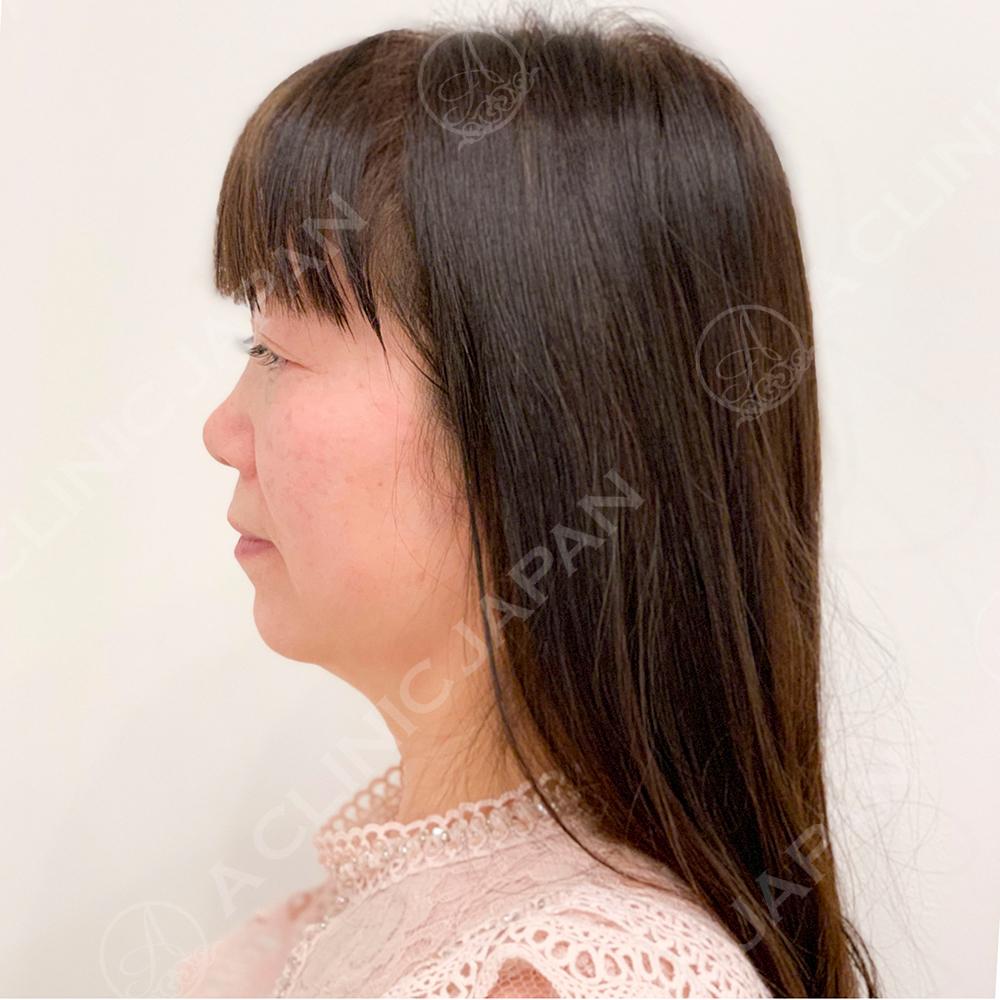たるみと重みでもたついていた二重あごがスッキリ 1day小顔脂肪吸引の処置前と1ヶ月後の症例です 50代女性 A Clinicは小顔 リフトアップ専門の美容整形クリニック