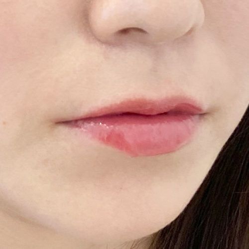 上唇がぷくっと立体感が出て可愛い唇に スマイルリップ処置前と処置直後です 30代女性 A Clinicは小顔 リフトアップ専門の美容整形クリニック