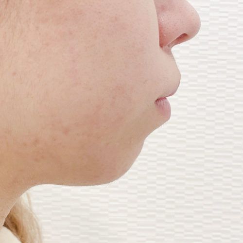 面長に見えると思っていませんか しっかりと前に出すデザインが可能 顎へのヒアルロン酸注入処置前と処置直後です 代女性 A Clinicは小顔 リフトアップ専門の美容整形クリニック