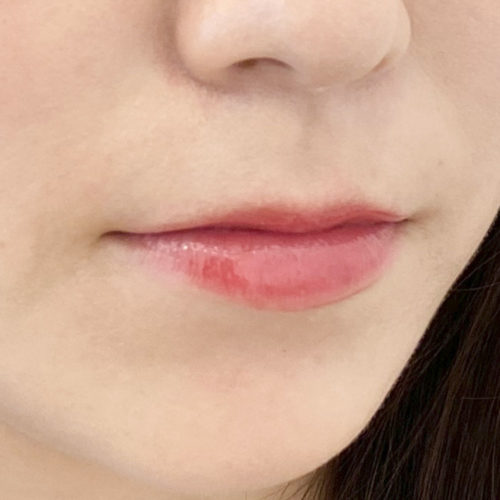 上唇がぷくっと立体感が出て可愛い唇に スマイルリップ処置前と処置直後です 30代女性 A Clinicは小顔 リフトアップ専門の美容整形クリニック