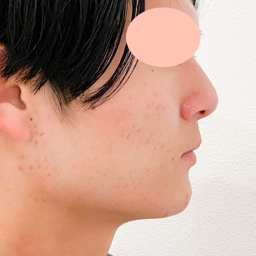 ニキビ肌や凸凹のお肌を美肌に改善 ダーマペン4の処置前と3回目処置後の症例です 代男性 美容整形のa Clinic 美容外科 美容皮膚科 形成外科