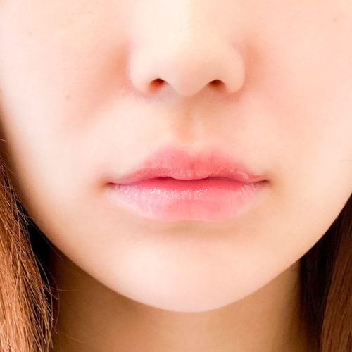 上唇のm字型と口角の角度が可愛いくちびるをつくる黄金比率です スマイルリップの処置前と処置直後の症例です 代女性 A Clinicは小顔 リフトアップ専門の美容整形クリニック