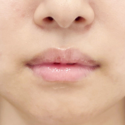 ナチュラルに口角上向き 可愛い唇のデザインならお任せください スマイルリップ処置前と処置直です 代女性 A Clinicは小顔 リフトアップ専門の美容整形クリニック