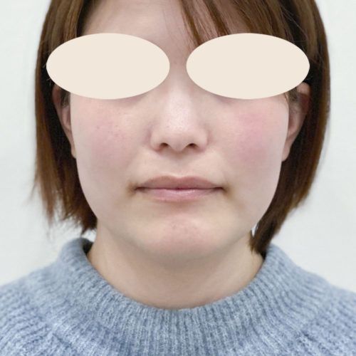 360度綺麗な輪郭を目指す方に 小顔輪郭形成術vフェイスのモニター症例です 30代女性 A Clinicは小顔 リフトアップ専門の美容整形クリニック