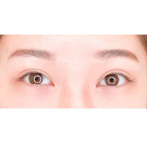 白目と黒目が広く強調されてパッチリとした印象に パーフェクトアイズの処置前と2週間後の症例です 代女性 A Clinicは小顔 リフトアップ専門の美容整形クリニック 白目と黒目が広く強調されてパッチリとした印象に パーフェクトアイズの処置前と2週間後の症例です 代女性 A Clinicは小顔 リフトアップ専門の美容整形クリニック