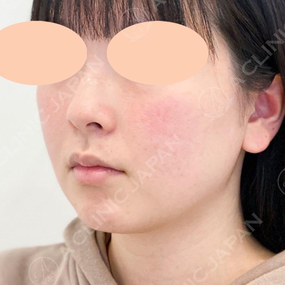 フェイスラインすっきり♪顔痩せ1day小顔脂肪吸引処置前と3週間後です(20代女性) | A CLINICは小顔・リフトアップ専門の美容整形クリニック