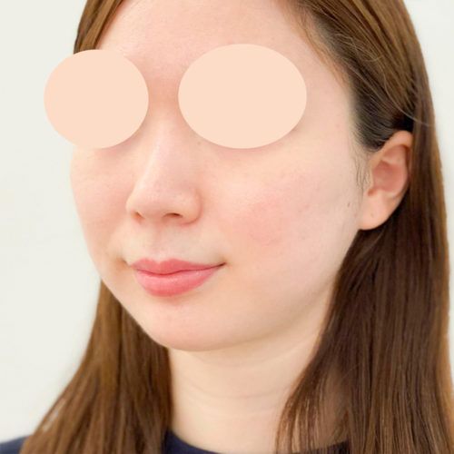 二重あごが解消され横から見ても綺麗な輪郭に 腫れの少ない1day小顔脂肪吸引の処置前と3週間後の症例です 代女性 美容整形のa Clinic 美容外科 美容皮膚科 形成外科 二重あごが解消され横から見ても綺麗な輪郭に 腫れの少ない1day小顔脂肪吸引の処置前と3週間後の症例です 代女性 美容整形のa Clinic 美容外科 美容皮膚科 形成外科
