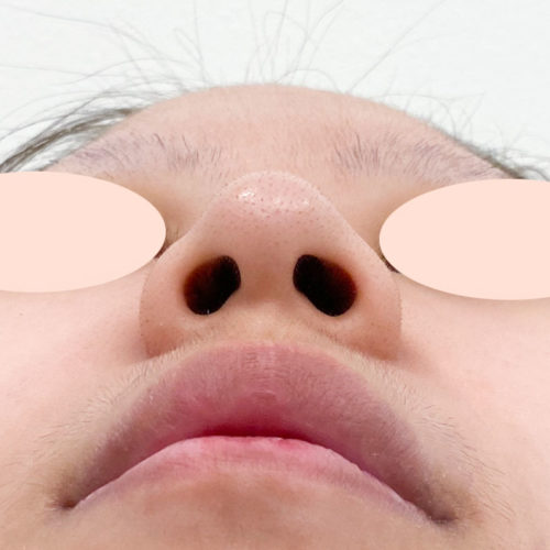 小鼻縮小術 外側切開法1ヶ月後の症例です 傷跡もここまで綺麗に 鼻の穴を小さくしたい方にも 代女性 A Clinicは小顔 リフトアップ専門の美容整形クリニック
