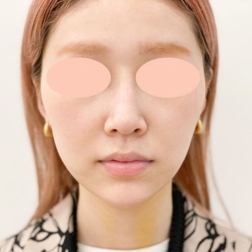 ダイエットでは落としにくいお顔のたるみを解消 1day小顔脂肪吸引の3日後の症例です 代女性 美容整形のa Clinic 美容外科 美容皮膚科 形成外科