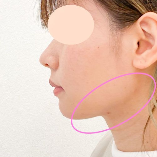 エラ下の脂肪吸引でくっきりフェイスラインに 1day小顔脂肪吸引3週間後の症例です 代女性 美容整形のa Clinic 美容外科 美容皮膚科 形成外科