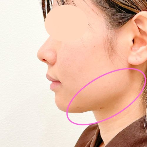 エラ下の脂肪吸引でくっきりフェイスラインに 1day小顔脂肪吸引3週間後の症例です 代女性 美容整形のa Clinic 美容外科 美容皮膚科 形成外科