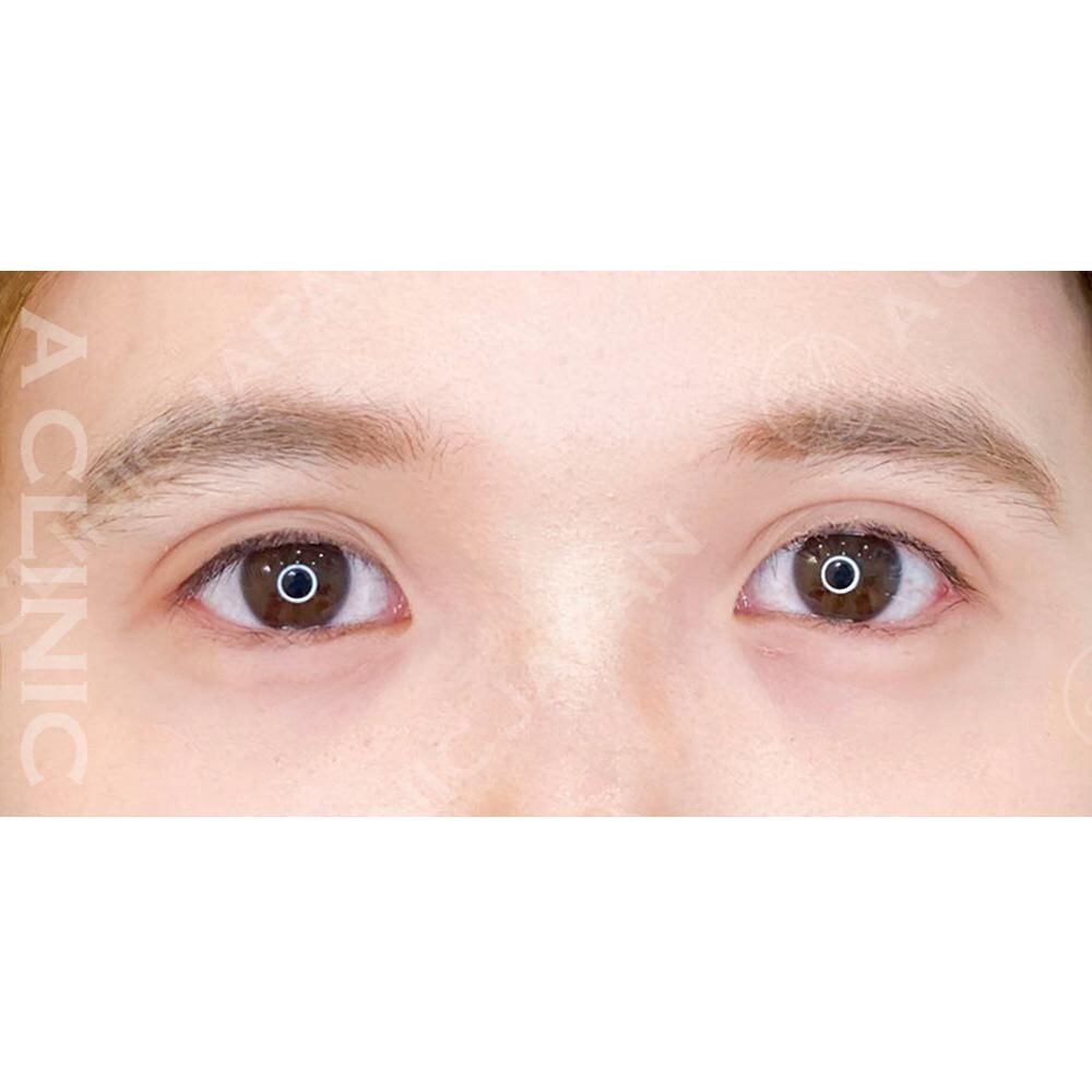 ナチュラルで可愛いタレ目に♡パーフェクトアイズの処置前と2週間後の症例です(20代女性) AFTER