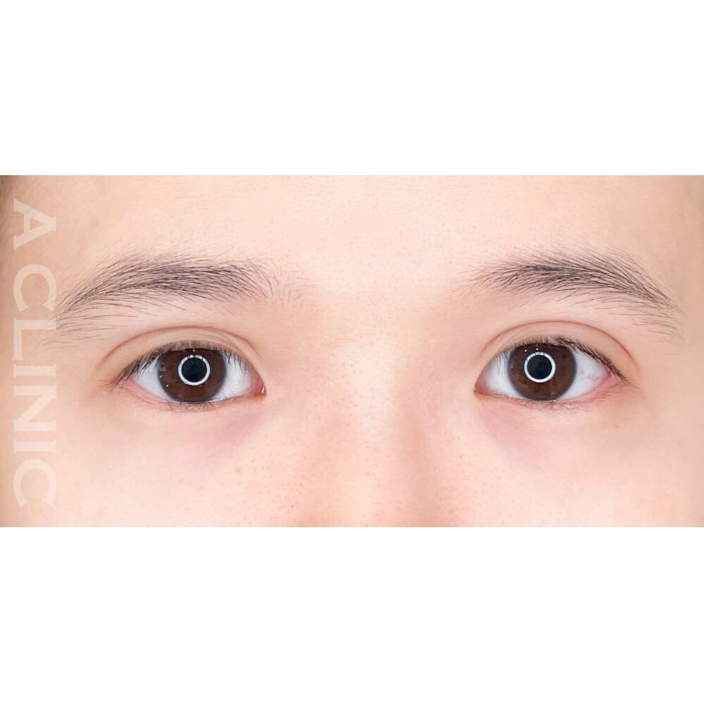 ナチュラルで可愛いタレ目に♡パーフェクトアイズの処置前と2週間後の症例です(20代女性) BEFORE