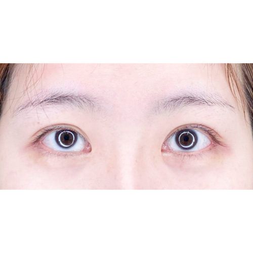 目を見開くクセがあり 額のシワ予防したい方に 眉下リフト 処置前と3週間後です 代女性 A Clinicは小顔 リフトアップ専門の美容整形クリニック