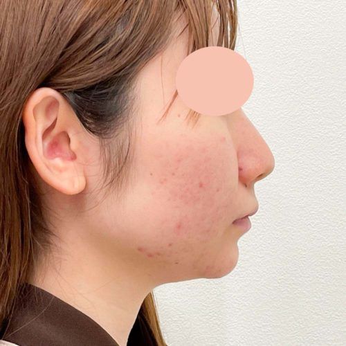 脂肪がつきやすい二重あごもご覧の通りスッキリ 1day小顔脂肪吸引の処置前と3週間後の症例です 代女性 A Clinicは小顔 リフトアップ専門の美容整形クリニック