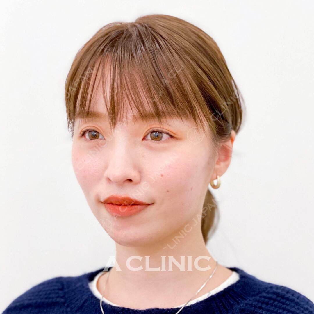 横からみてもしっかりフェイスラインが引き上がってます♬Aスレッドの直前直後のお写真です！(30代女性) AFTER