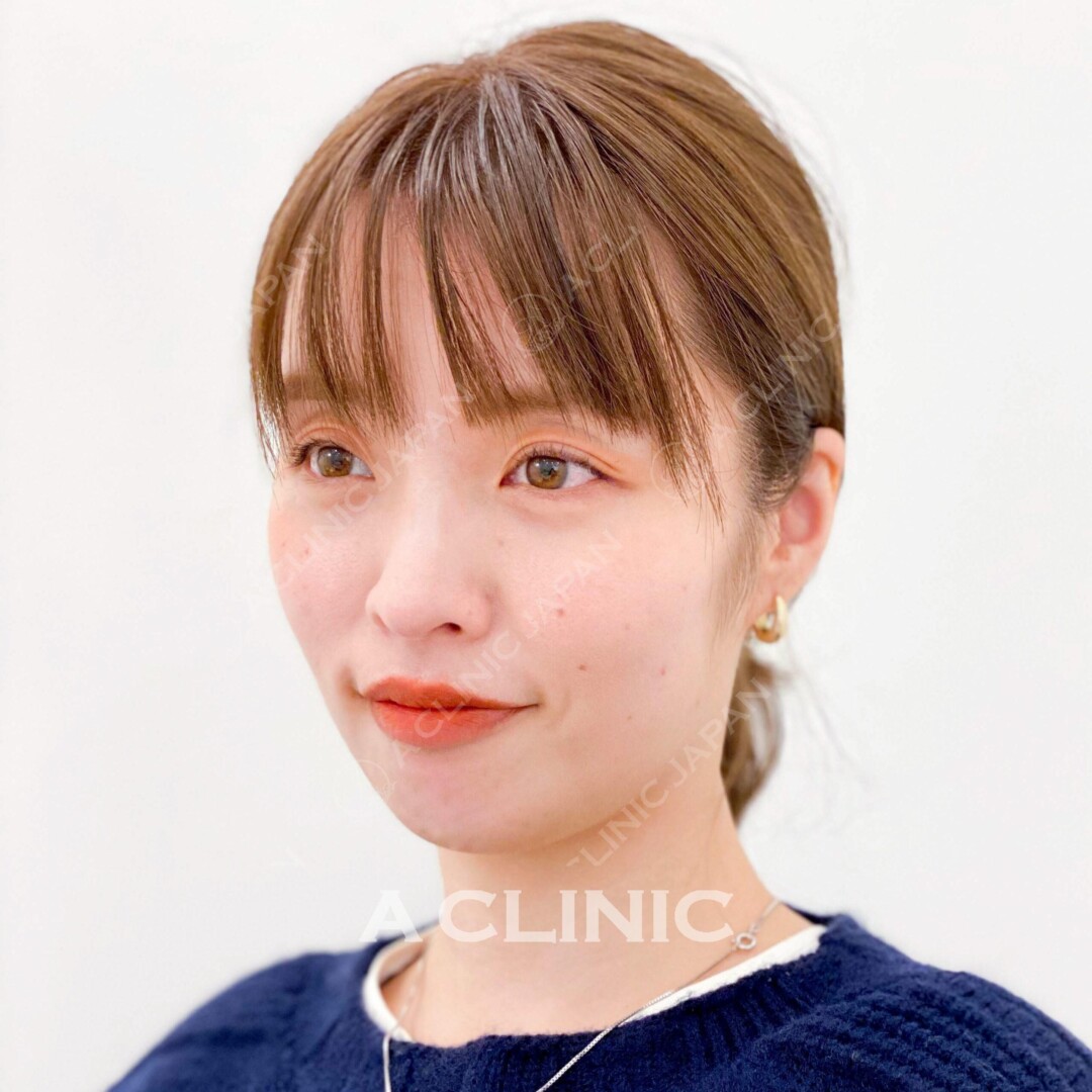 横からみてもしっかりフェイスラインが引き上がってます♬Aスレッドの直前直後のお写真です！(30代女性) BEFORE