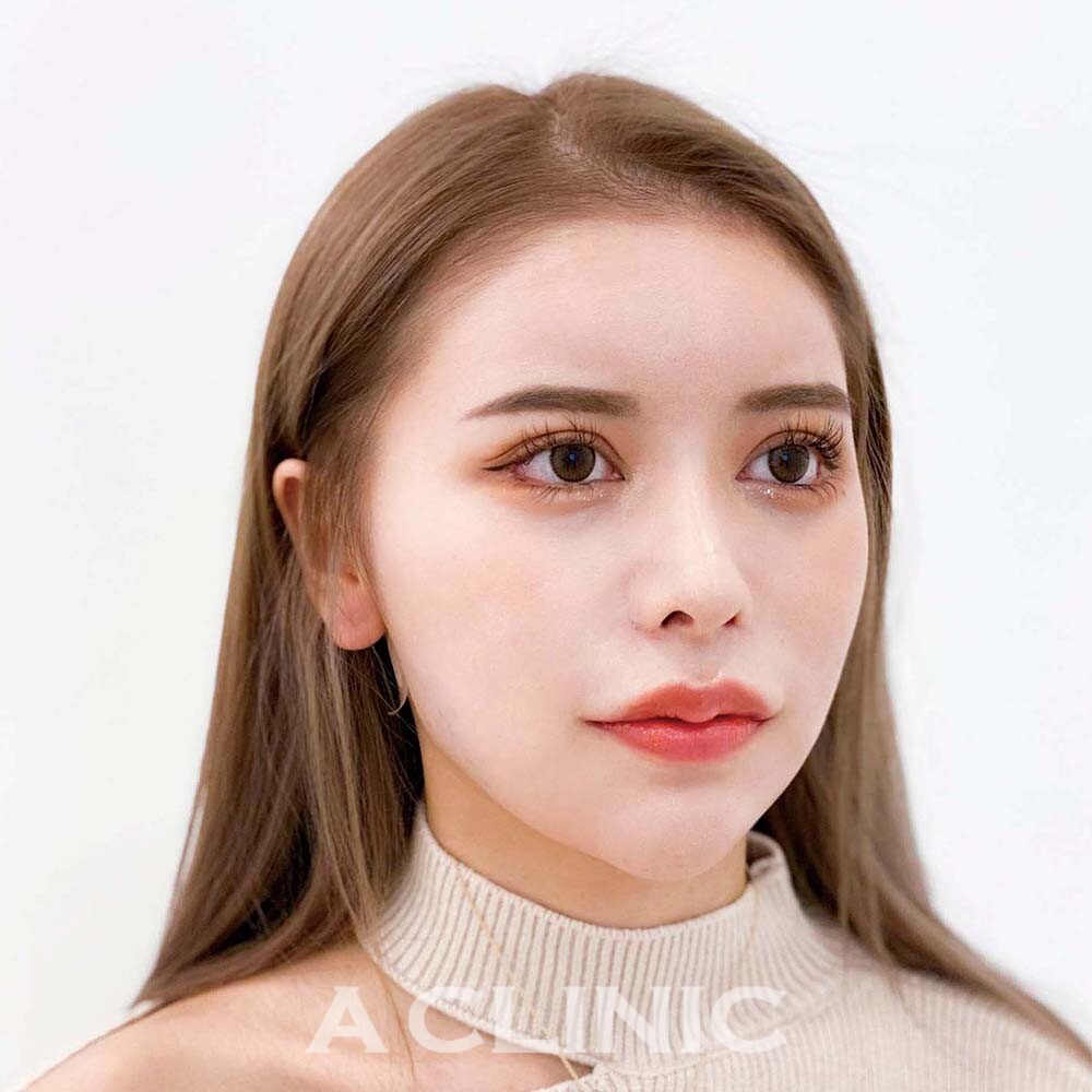 小顔や顔痩せをするなら♪圧倒的に腫れが少ない1day小顔脂肪吸引の処置前と処置直後の症例です(20代女性) AFTER