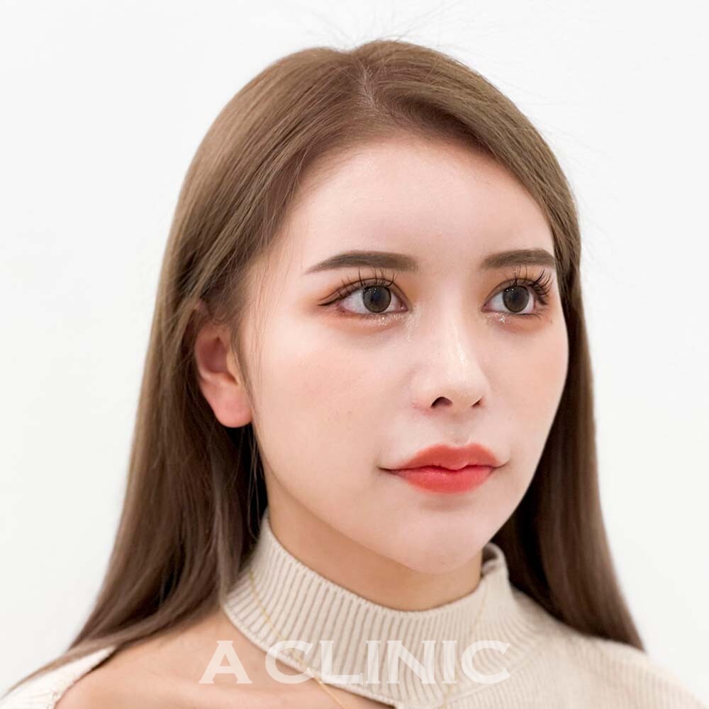 小顔や顔痩せをするなら♪圧倒的に腫れが少ない1day小顔脂肪吸引の処置前と処置直後の症例です(20代女性) BEFORE