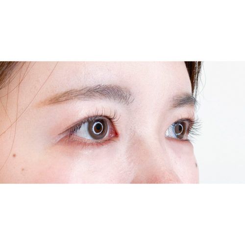 目頭切開でクリっとした可愛い目元へ こちら処置前と処置2週間後の症例です 代女性 A Clinicは小顔 リフトアップ専門の美容整形クリニック