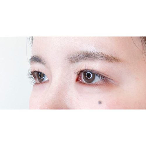 目頭切開法で蒙古襞 もうこひだ を除去 目頭切開法 処置前と処置2週間後です 代女性 A Clinicは小顔 リフトアップ専門の美容整形クリニック 目頭切開法で蒙古襞 もうこひだ を除去 目頭切開法 処置前と処置2週間後です 代女性 A Clinicは小顔 リフトアップ専門の美容整形クリニック