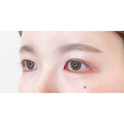 目頭切開法で蒙古襞 もうこひだ を除去 目頭切開法 処置前と処置2週間後です 代女性 A Clinicは小顔 リフトアップ専門の美容整形クリニック