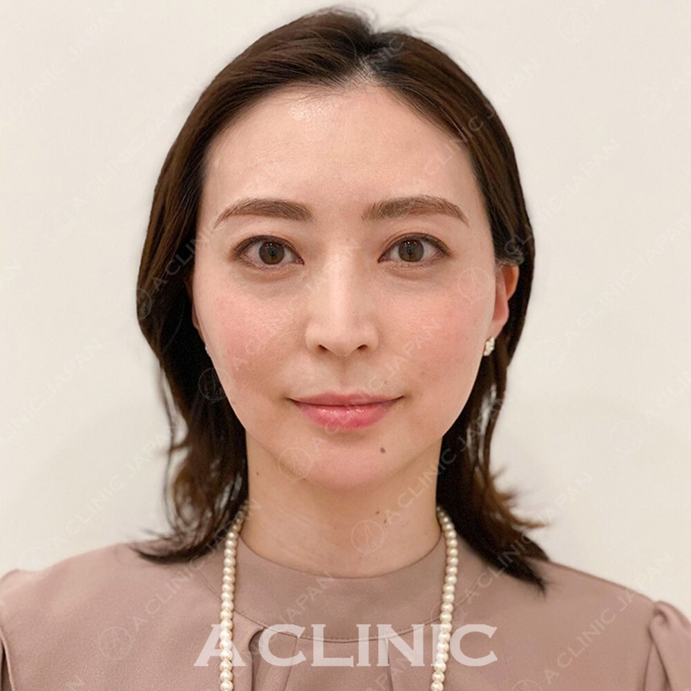 フェイスラインのもたつきがその日に解消されます♪Aスレッドの処置前と処置直後の症例です(30代女性) AFTER