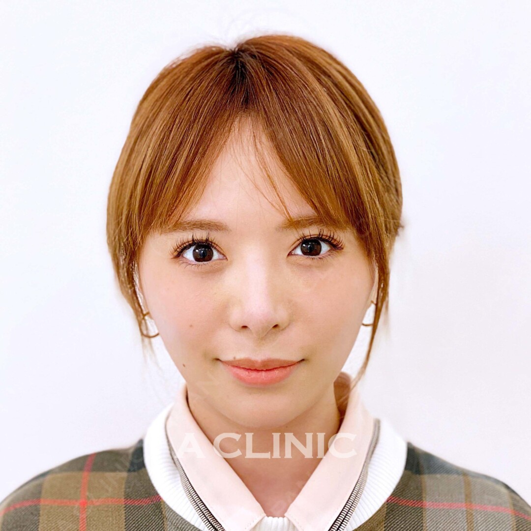 Aスレッドで小顔美人になれる 大事な予定のその前に！処置前、処置直後の症例です（30代女性) AFTER