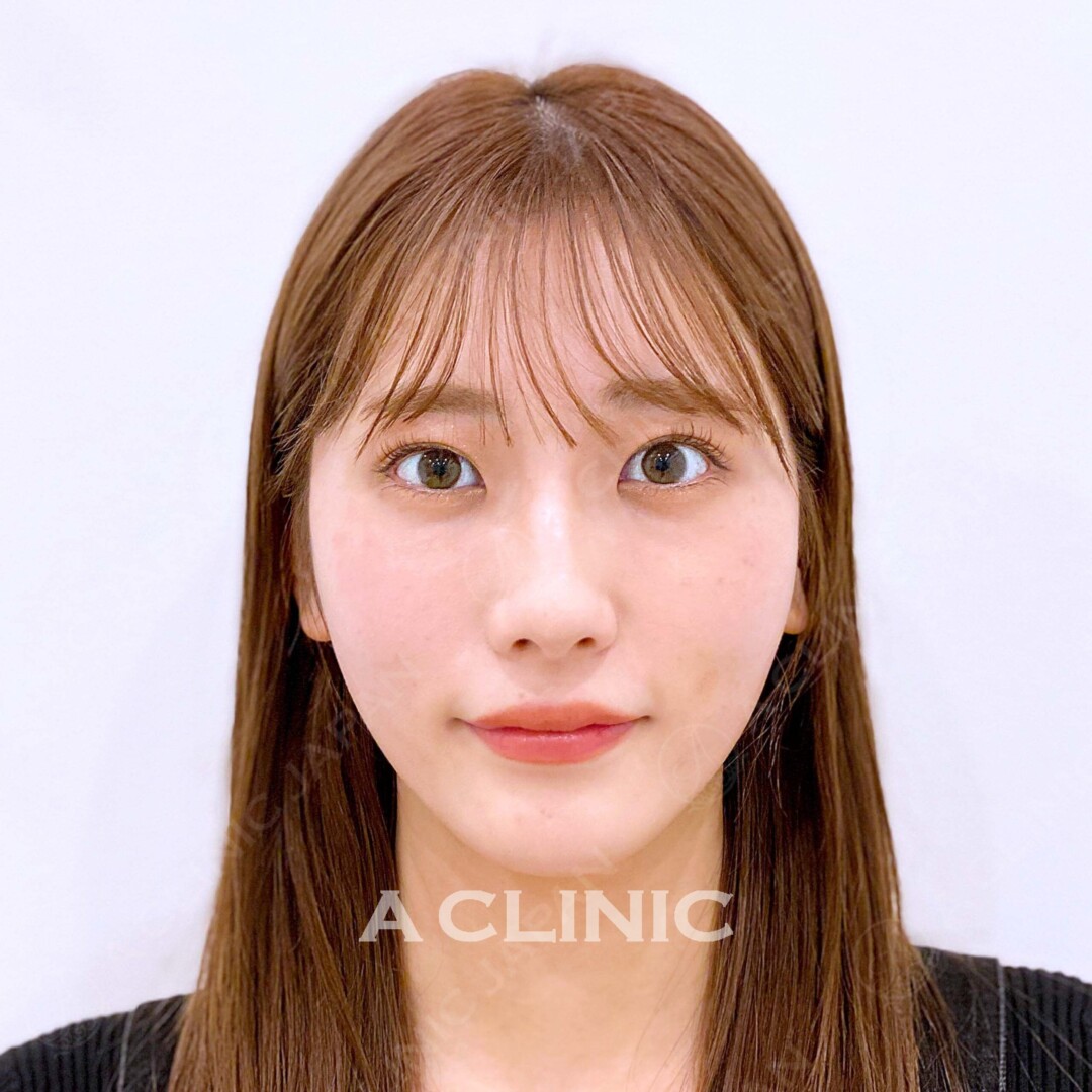 Aスレッドでもたつきを解消！待ち合わせの空き時間にこっそり小顔に 処置前、処置直後の症例です（20代女性) AFTER