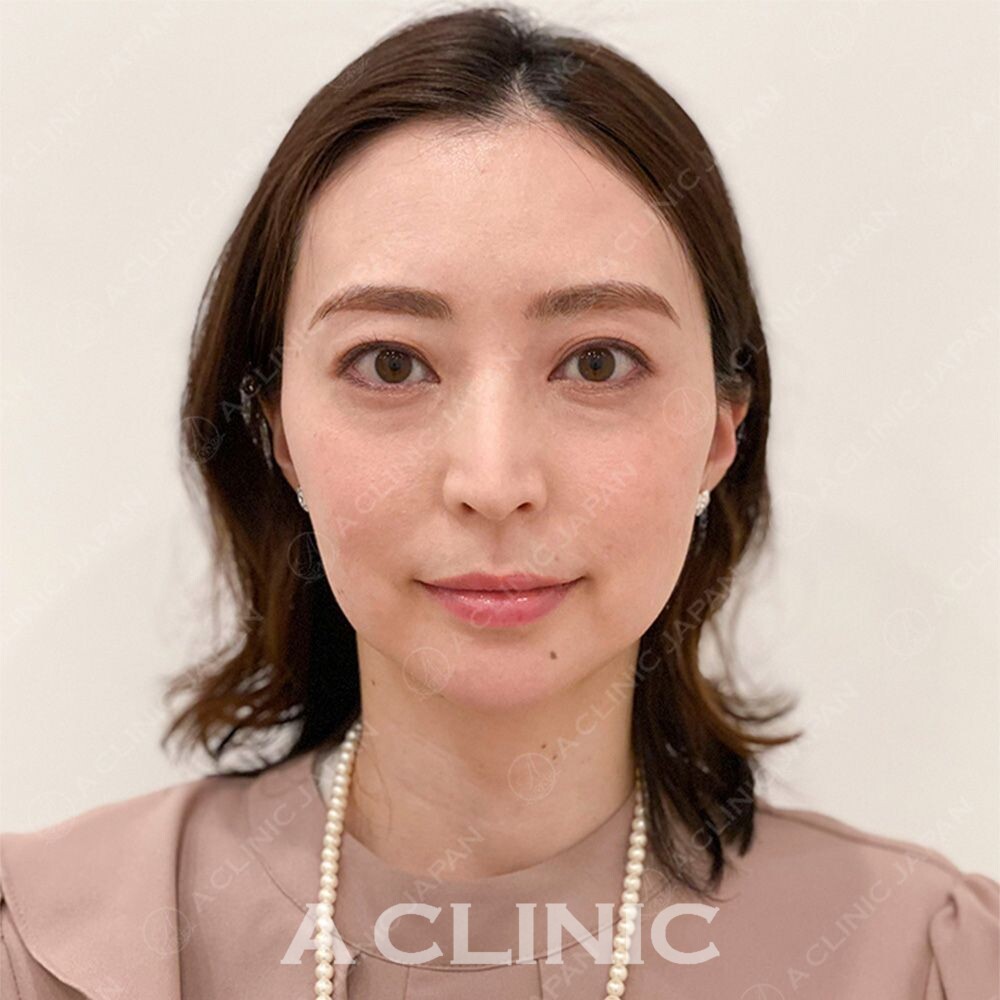 フェイスラインのもたつきがその日に解消されます♪Aスレッドの処置前と処置直後の症例です(30代女性) BEFORE