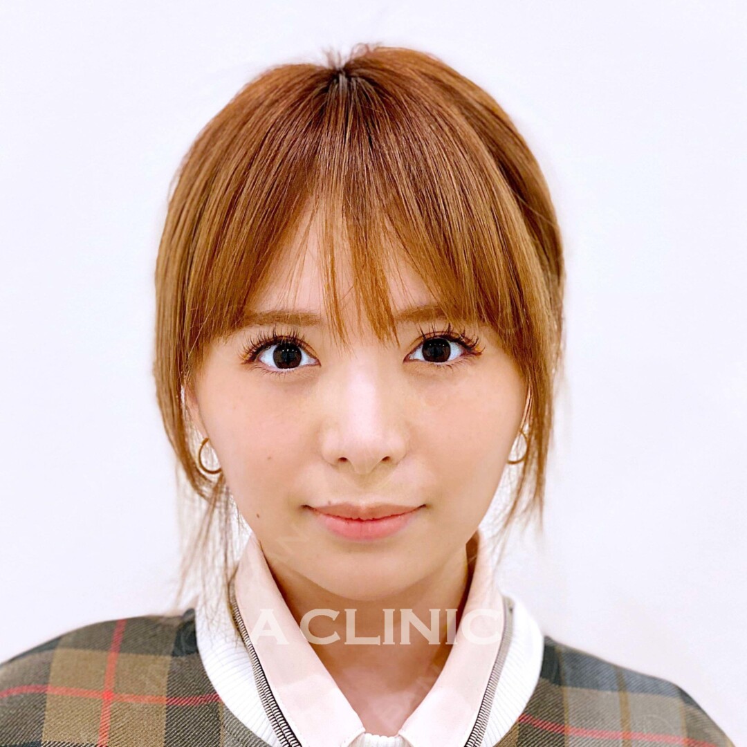 Aスレッドで小顔美人になれる 大事な予定のその前に！処置前、処置直後の症例です（30代女性) BEFORE