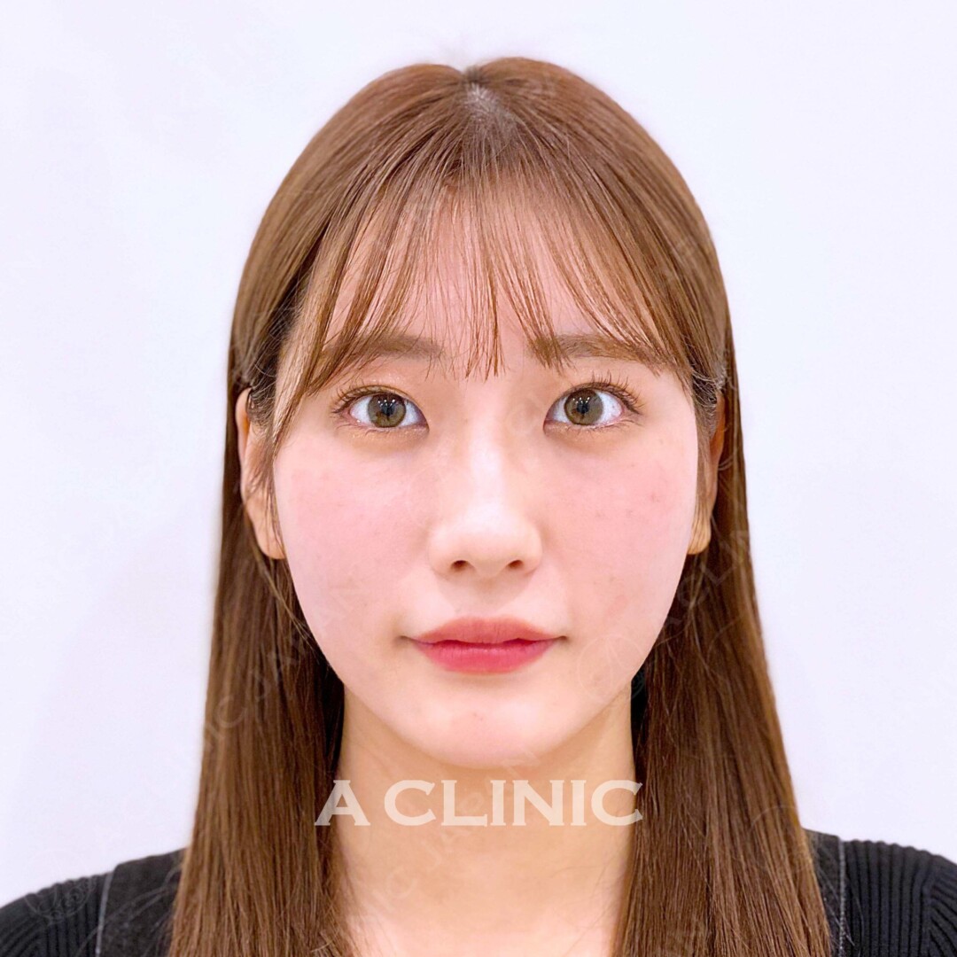 Aスレッドでもたつきを解消！待ち合わせの空き時間にこっそり小顔に 処置前、処置直後の症例です（20代女性) BEFORE