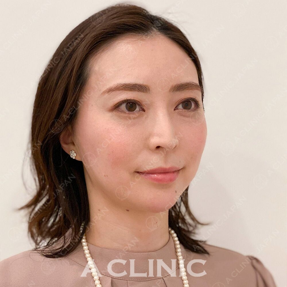 Aスレッドならわずか15分でアンチエイジングが叶います♪処置前と処置直後の症例です(30代女性) AFTER