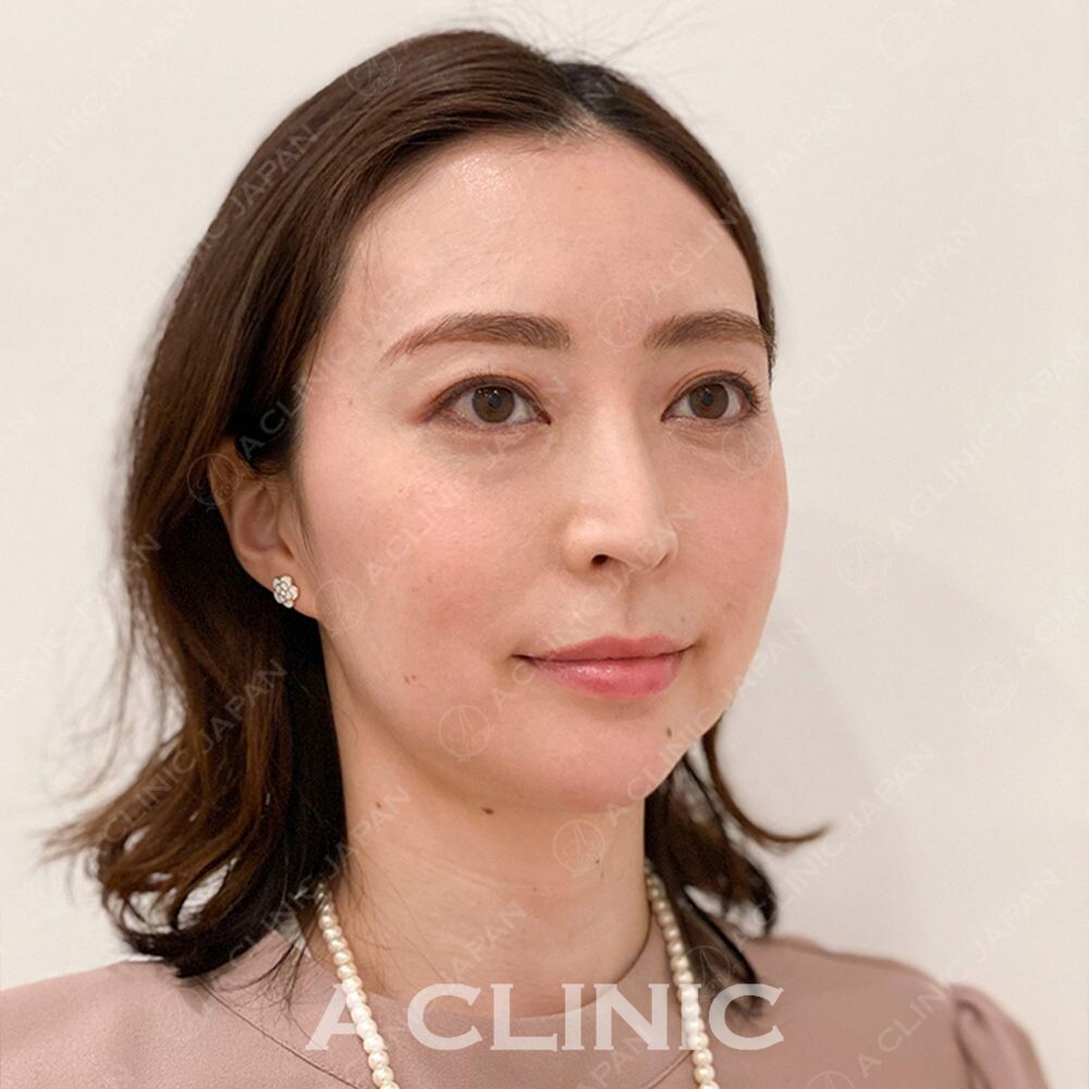 Aスレッドならわずか15分でアンチエイジングが叶います♪処置前と処置直後の症例です(30代女性) BEFORE