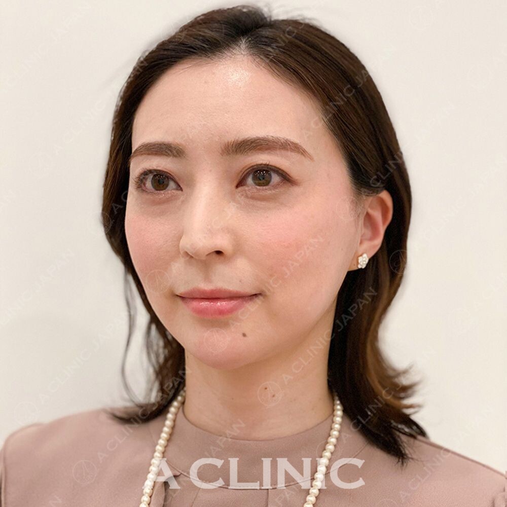 Aスレッドでたるみを引き上げどの角度から見ても美人に♪処置前と処置直後の症例です(30代女性) AFTER