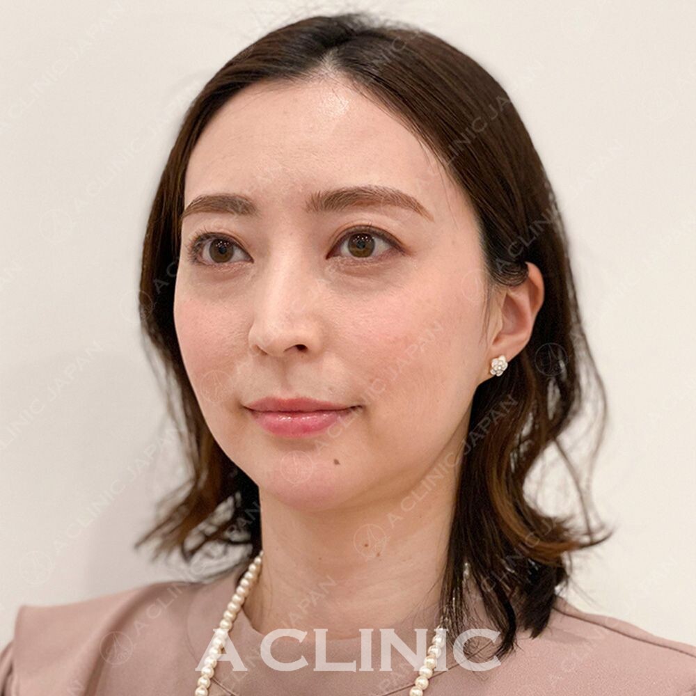 Aスレッドでたるみを引き上げどの角度から見ても美人に♪処置前と処置直後の症例です(30代女性) BEFORE
