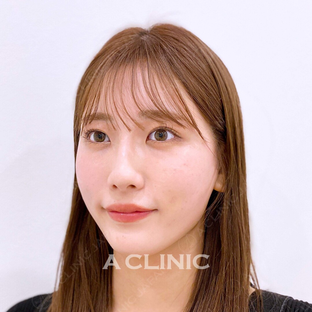 Aスレッドで短時間で驚きの引きあがり！美肌効果も！処置前、処置直後の症例です(20代女性) AFTER