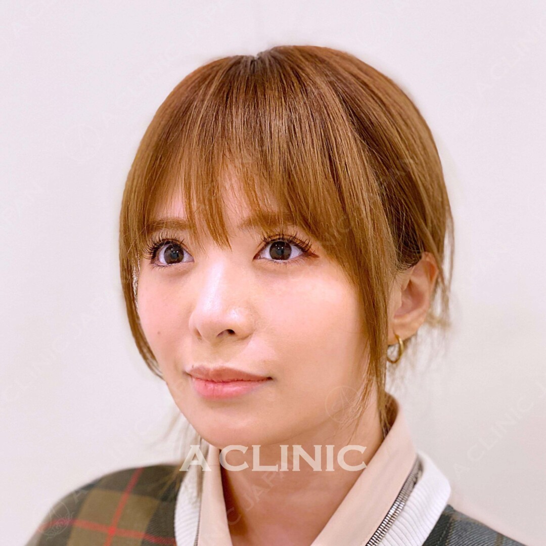 サクッと小顔に！買い物のついでにAスレッド 処置前と処置直後の症例です（30代女性) BEFORE