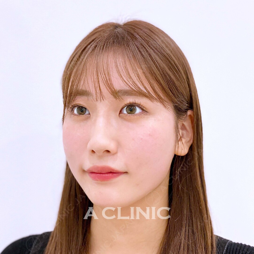 Aスレッドで短時間で驚きの引きあがり！美肌効果も！処置前、処置直後の症例です(20代女性) BEFORE