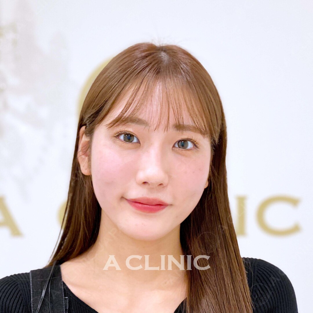 Aスレッドでサクッとしわやたるみ予防を！輪郭に自信が持てる 処置前、処置直後の症例です(20代女性) BEFORE