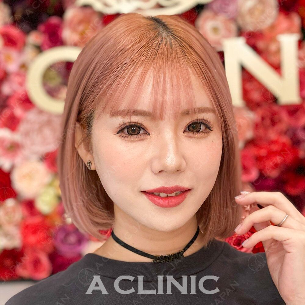 小顔になりたい方必見!!Aスレッドで即日小顔♡処置前と処置直後の症例です(20代女性) AFTER