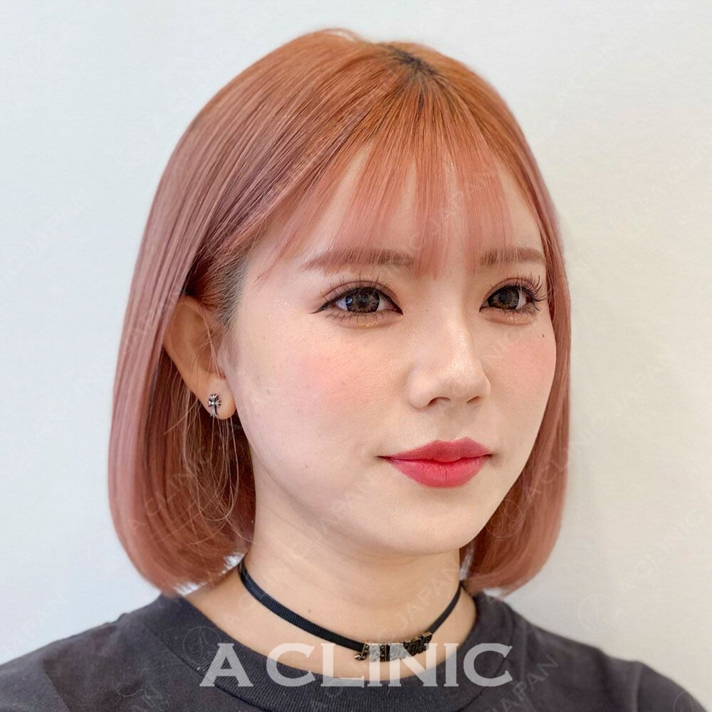 Aスレッドならその日から小顔美人♪こちら処置前と処置直後です(20代女性) AFTER