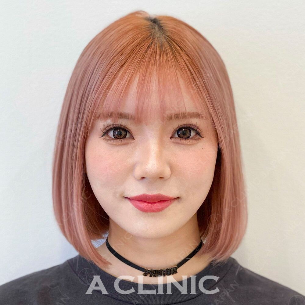 もたっとしていた輪郭がキュッと小顔に♡Aスレッドの処置前と処置直後の症例です(20代女性) AFTER