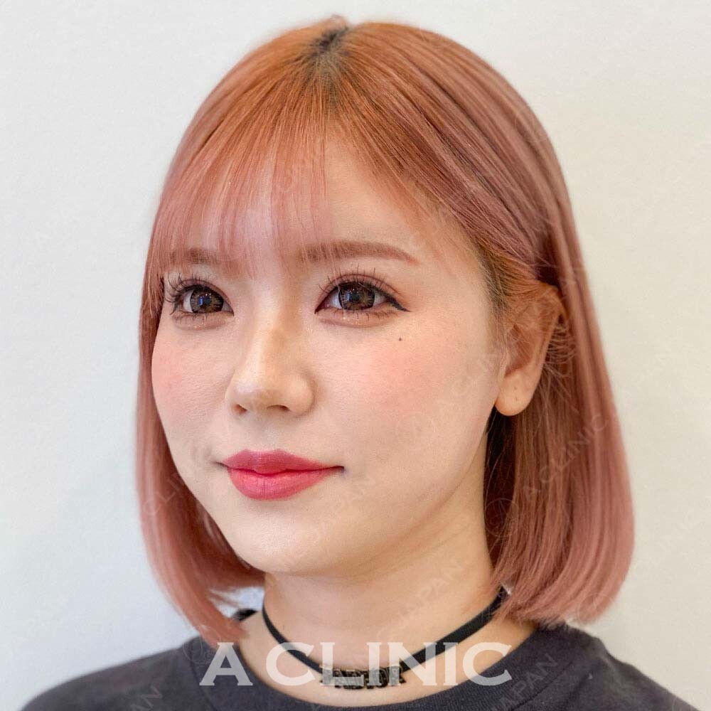 輪郭がくっきり変化！Aスレッド処置前と処置直後の症例です(20代女性) AFTER