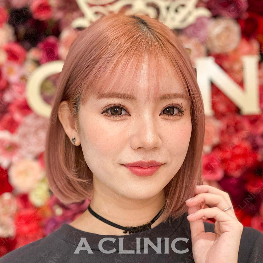 小顔になりたい方必見!!Aスレッドで即日小顔♡処置前と処置直後の症例です(20代女性) BEFORE