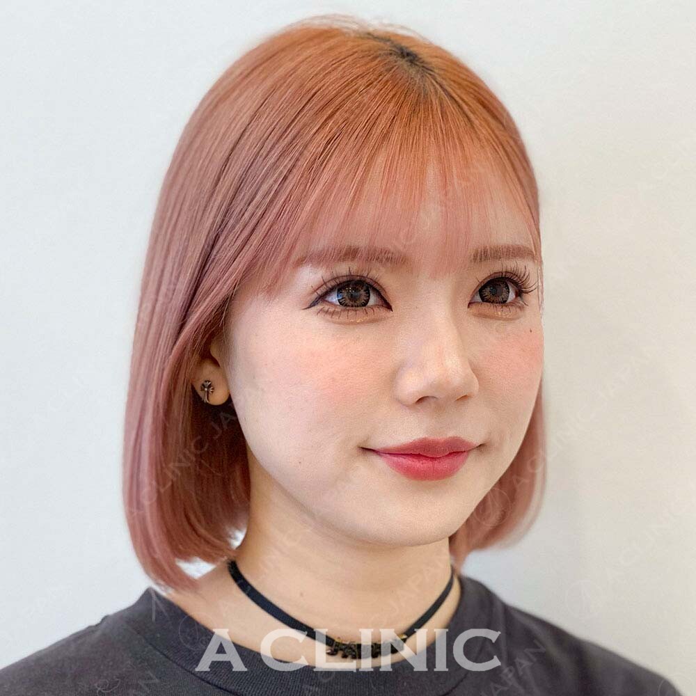 Aスレッドならその日から小顔美人♪こちら処置前と処置直後です(20代女性) BEFORE