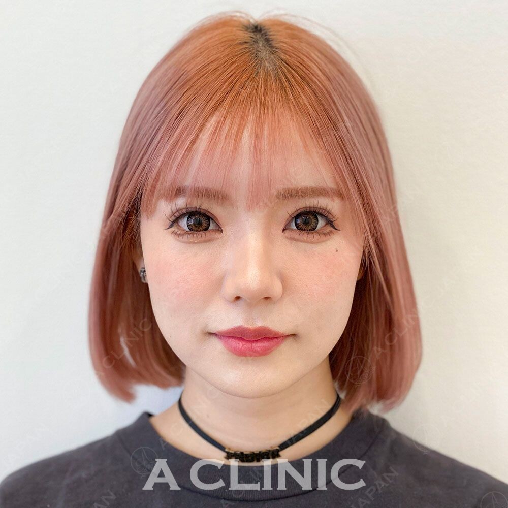 もたっとしていた輪郭がキュッと小顔に♡Aスレッドの処置前と処置直後の症例です(20代女性) BEFORE